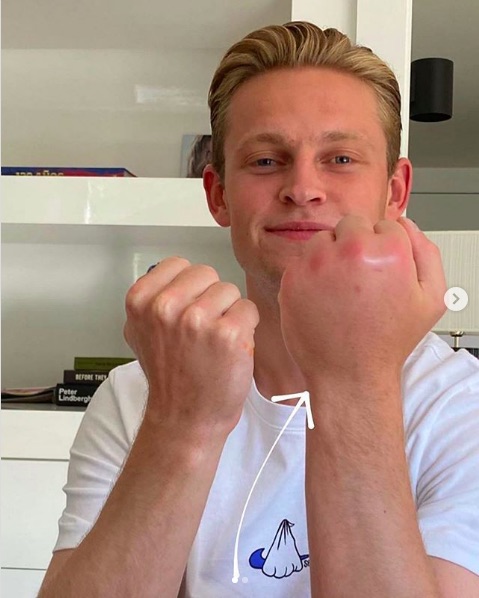 Frenkie de Jong bee sting