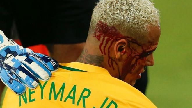 Neymar injury