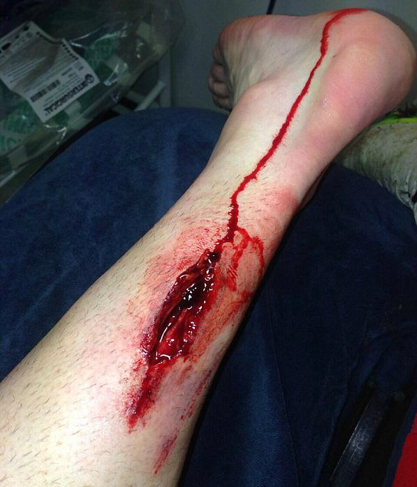 stephen ireland gash leg